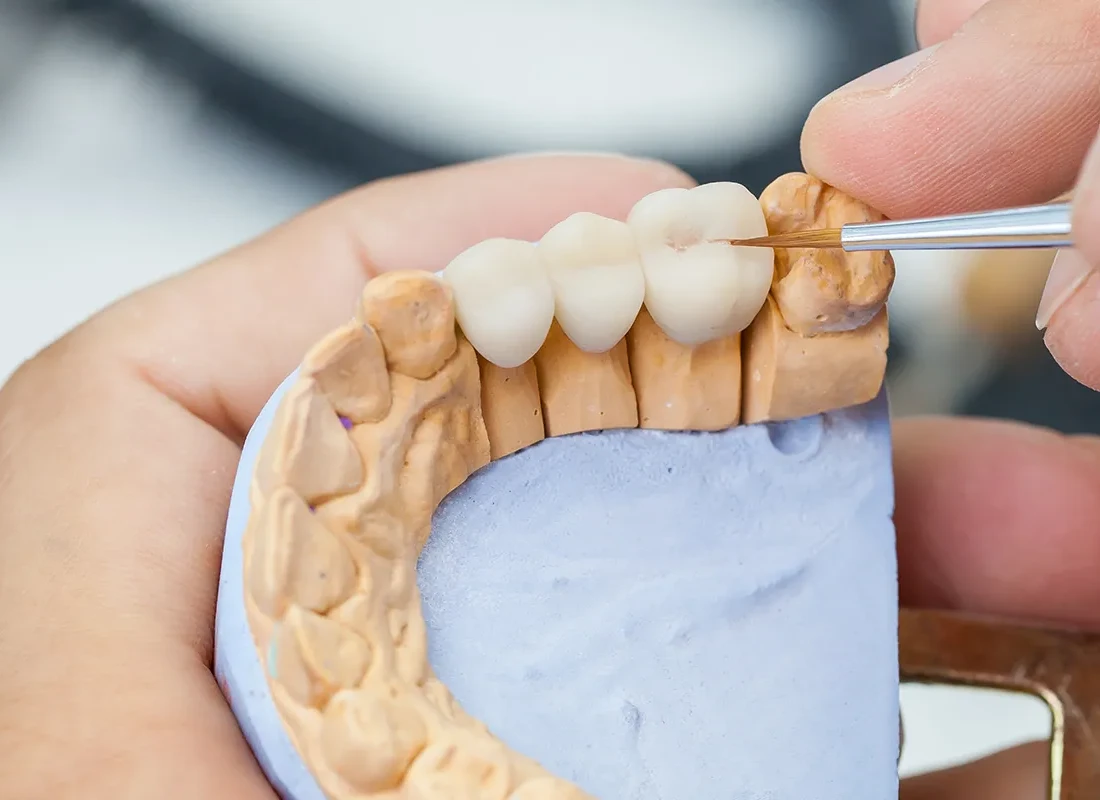 Dental Bridge in Beverly Hills, CA