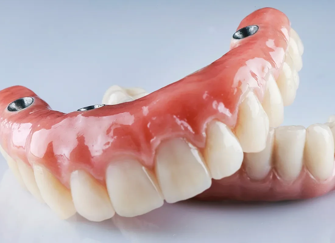Implant-Supported Denture Restoration in Beverly Hills, CA