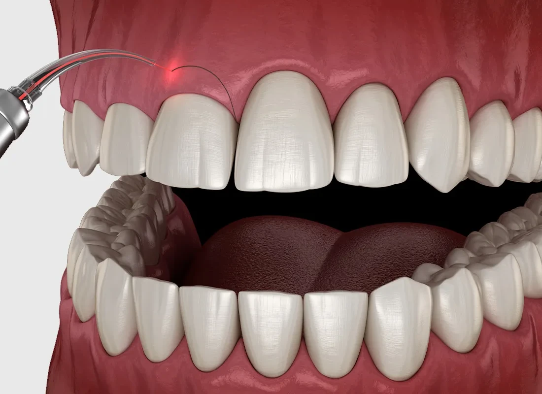 Gummy Smile Correction vs. Veneers: Which Actually Fixes a Gummy Smile — Beverly Hills Cosmetic Dentistry