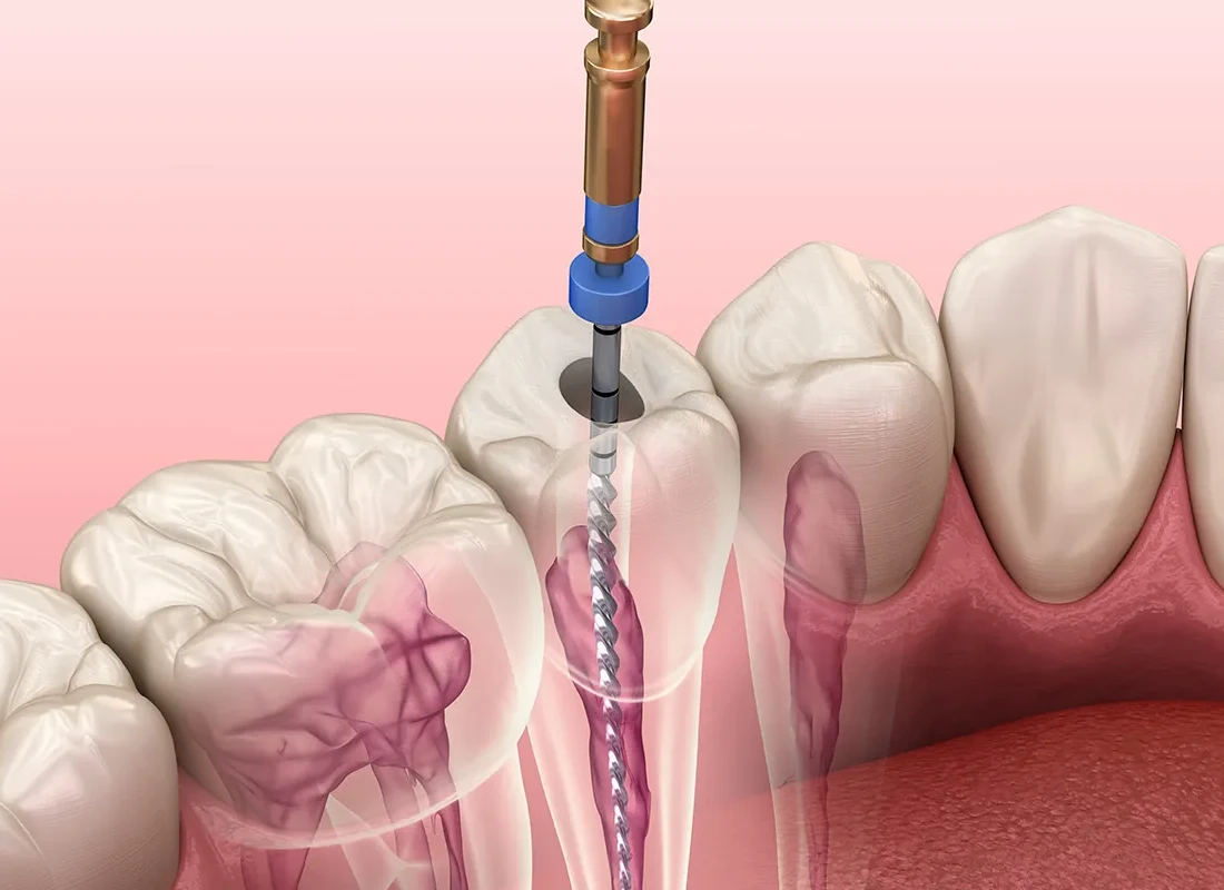 Does a Root Canal Hurt? What the Procedure Is Really Like — Beverly Hills Cosmetic Dentistry