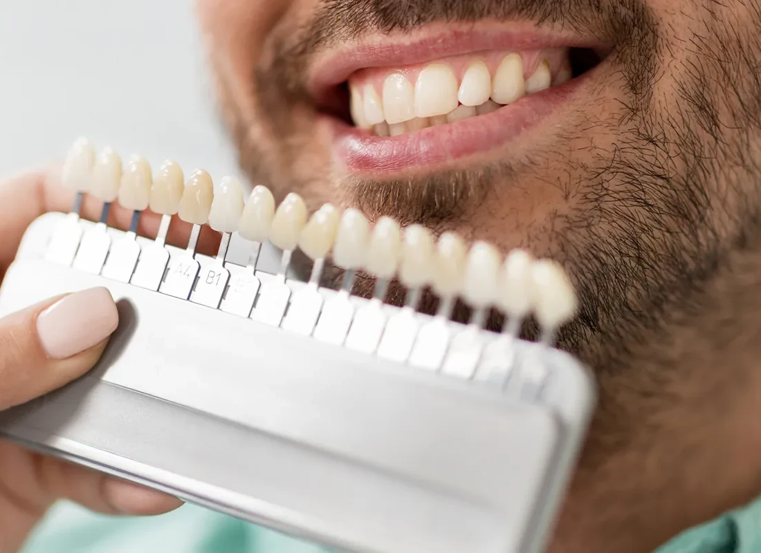 Does Teeth Whitening Last Longer With Trays or In-Office — Beverly Hills Cosmetic Dentistry
