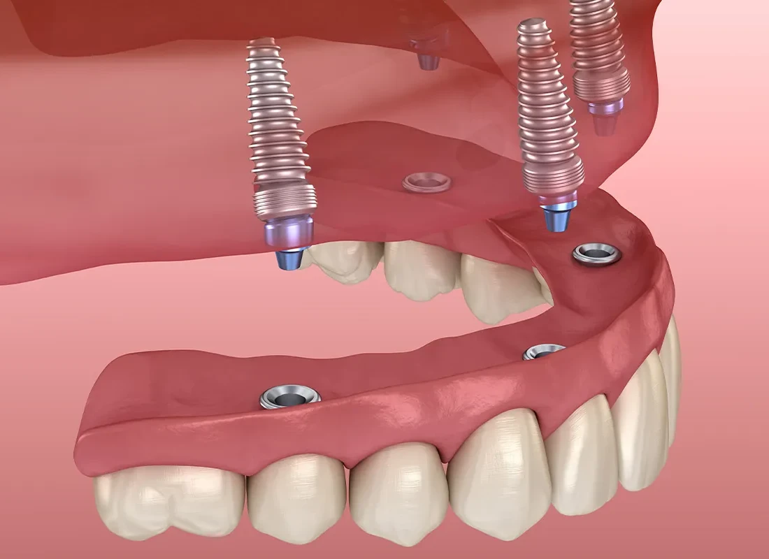 All-on-4 Implants vs. Traditional Dentures — Beverly Hills Cosmetic Dentistry