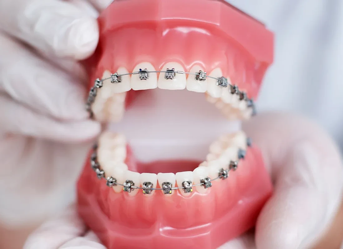 braces Patient with orthodontics in Beverly Hills
