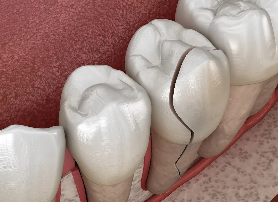 What Should I Do If I Break a Tooth on Something Hard In Beverly Hills, CA — Beverly Hills Cosmetic Dentistry