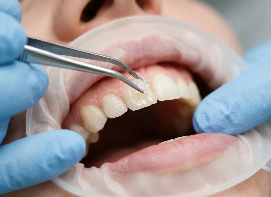 The Importance of Dental Fillings — Beverly Hills Cosmetic Dentistry