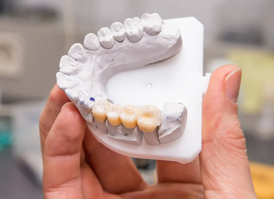 Dental Bridge at Beverly Hills Cosmetic Dentistry