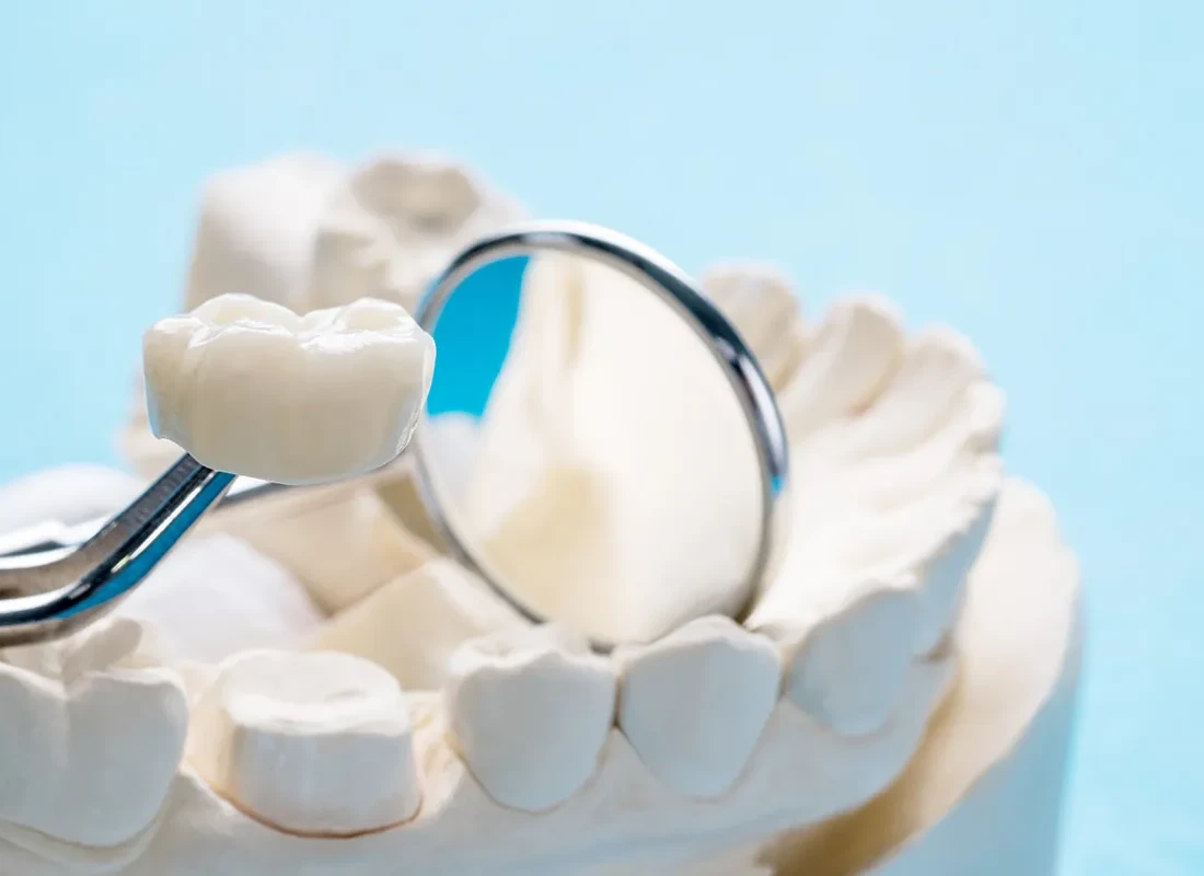 Porcelain Crowns at Beverly Hills Cosmetic Dentistry