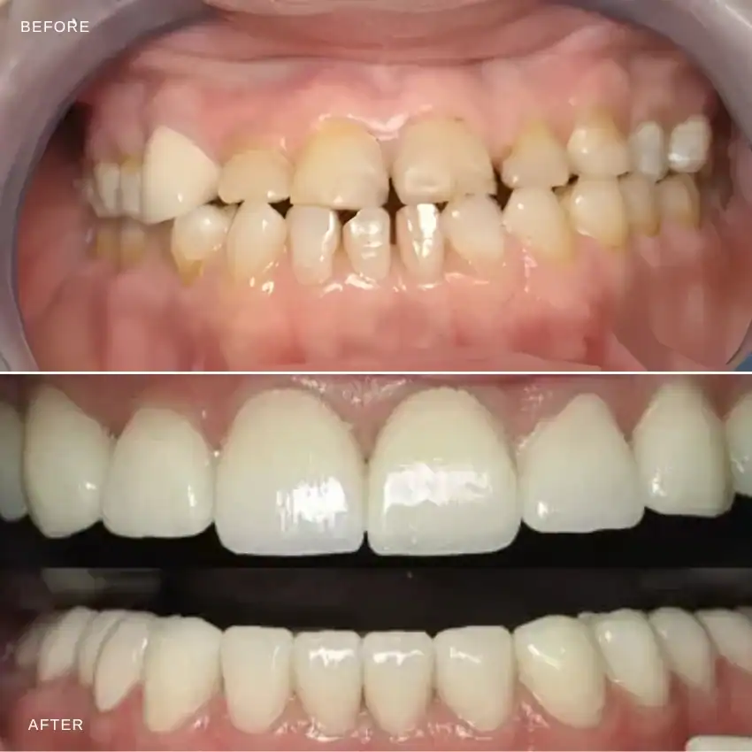 Signs you may need smile design / smile makeovers — Beverly Hills Cosmetic Dentistry