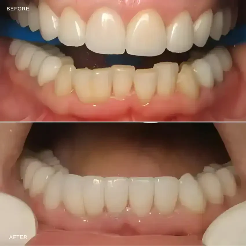 Before and after — Dental Crowns