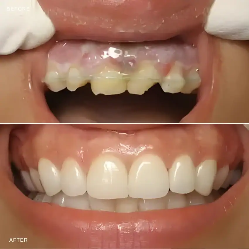 Before and after — Dental Crowns