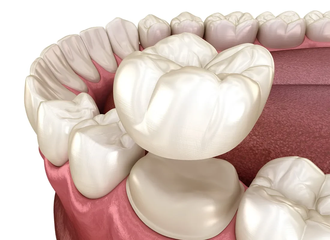 All You Need to Know About Dental Bridges — Beverly Hills Cosmetic Dentistry