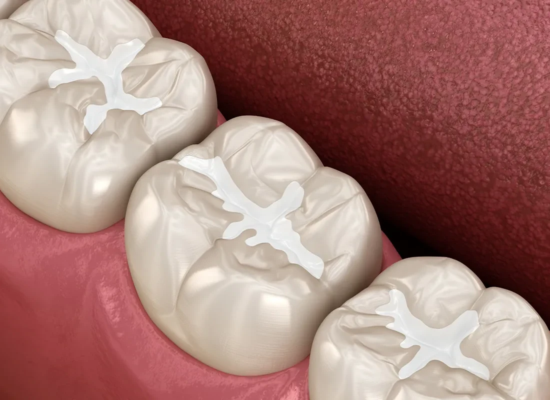 White Filling / State of the Art Bonding at Beverly Hills Cosmetic Dentistry
