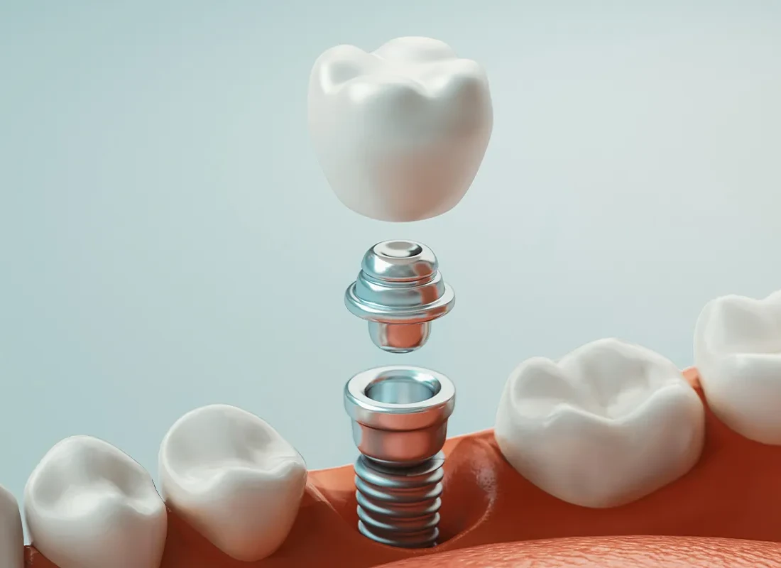 getting dental implants