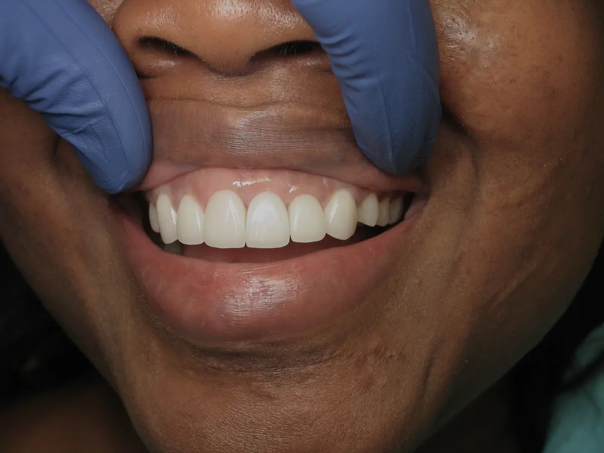 After — Dental Implants — Case 1