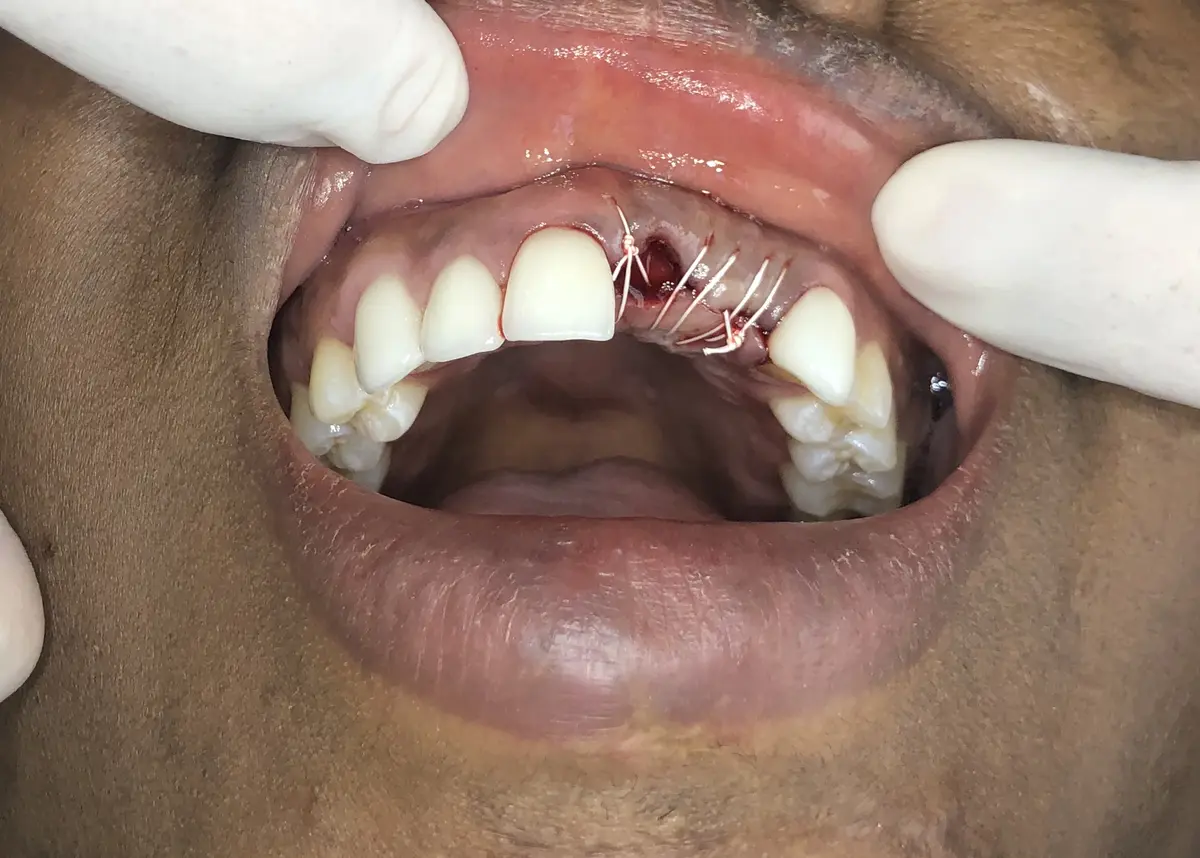 Before — Dental Implants — Case 1