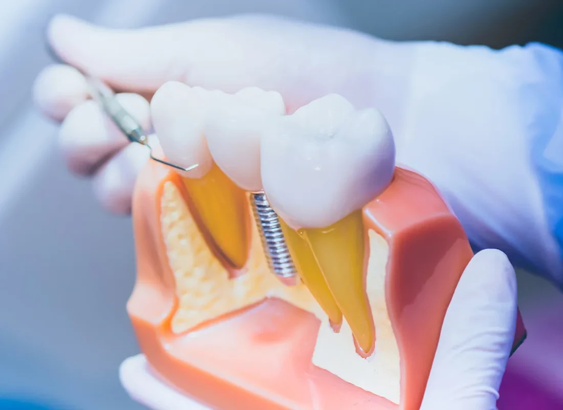 What Should I Know About Getting Dental Implants After Tooth Loss — Beverly Hills Cosmetic Dentistry
