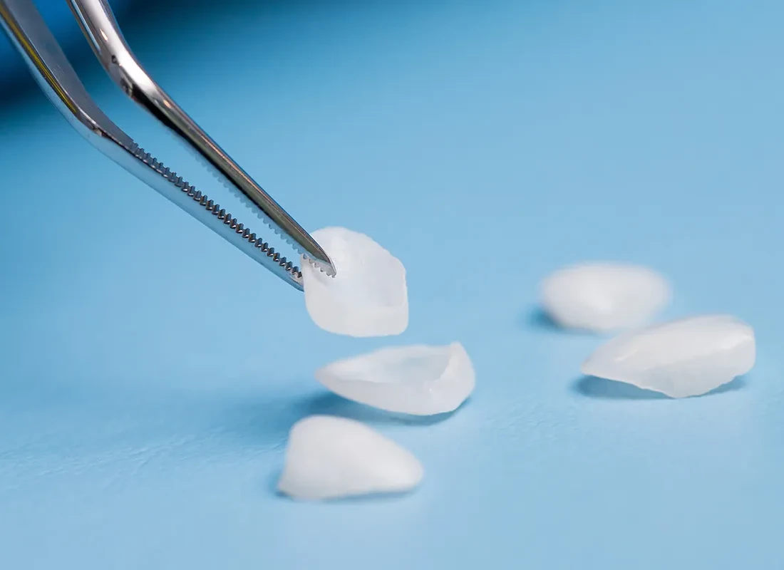 Signs you may need porcelain veneers — Beverly Hills Cosmetic Dentistry