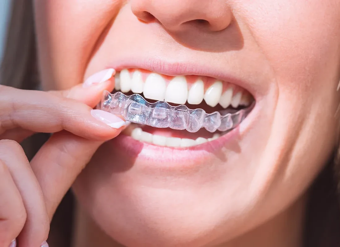 Custom Nightguards & Athletic Mouthguards at Beverly Hills Cosmetic Dentistry
