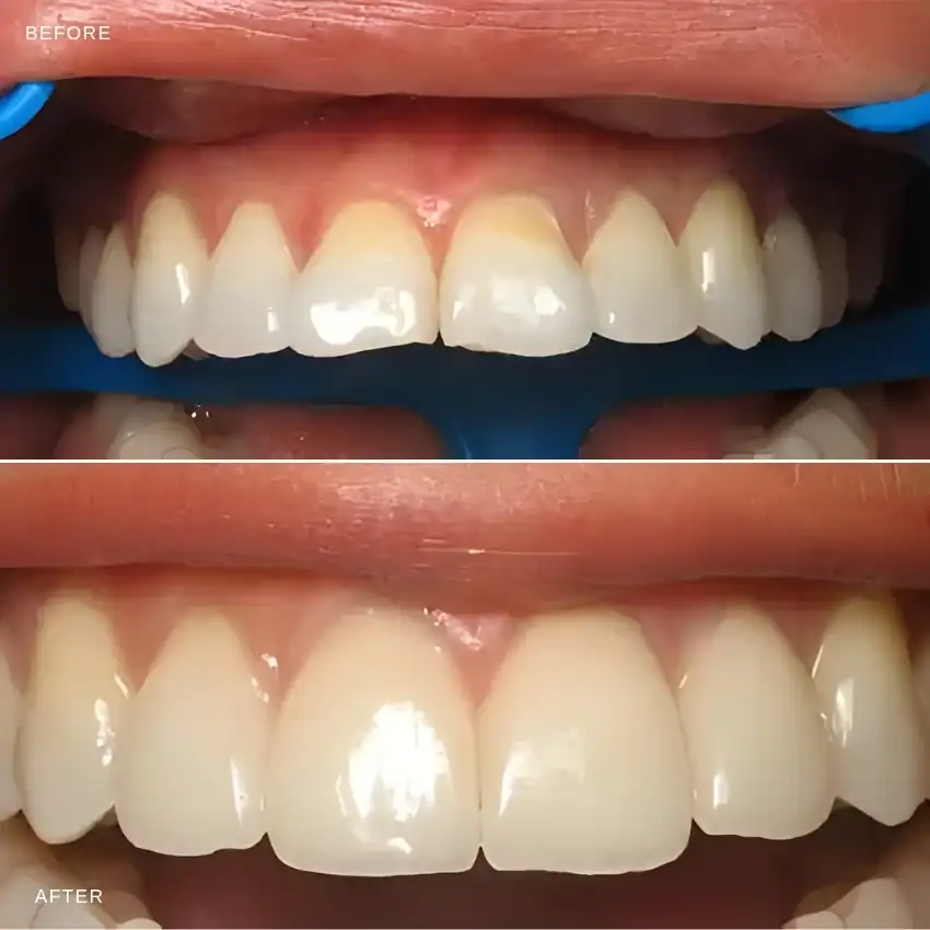 Before and after — Porcelain Veneers — Case 1