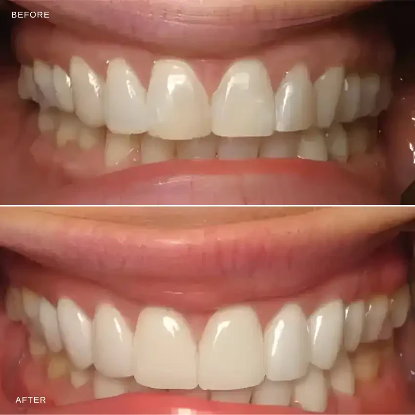 Before and after — Porcelain Veneers — Case 2