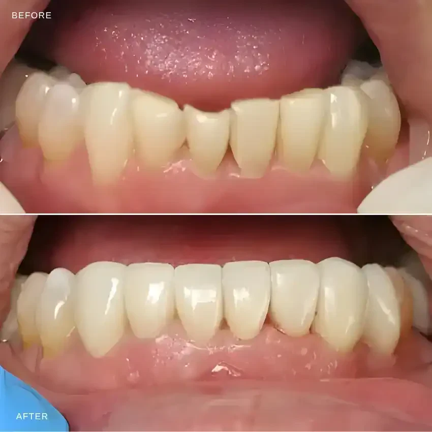 Before and after — Porcelain Veneers — Case 3