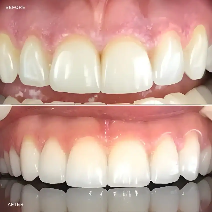 Before and after — Porcelain Veneers — Case 4