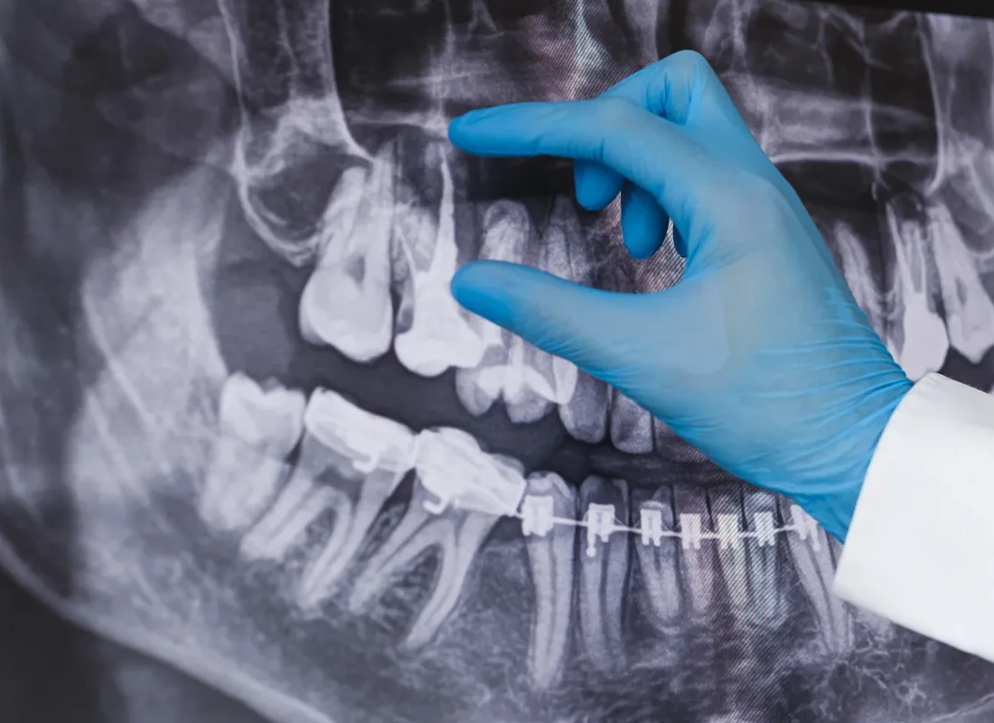 Root canal in Beverly Hills