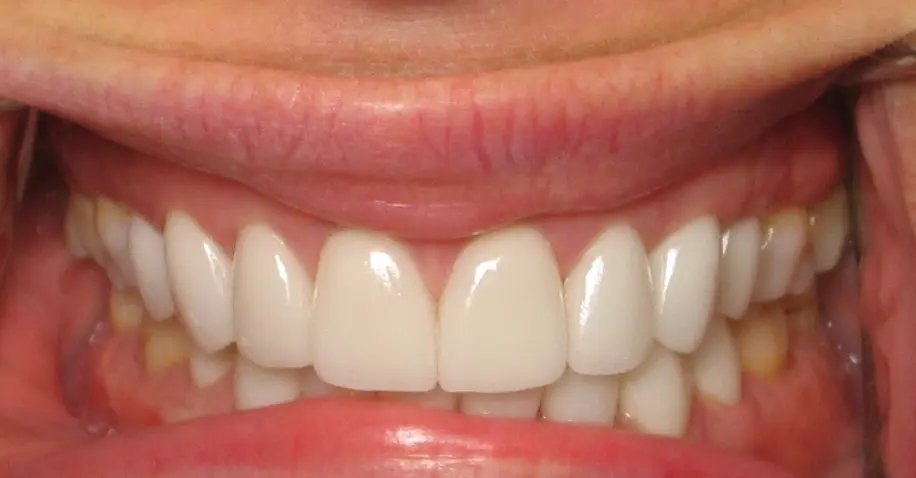 After — Smile Makeover — Case 4