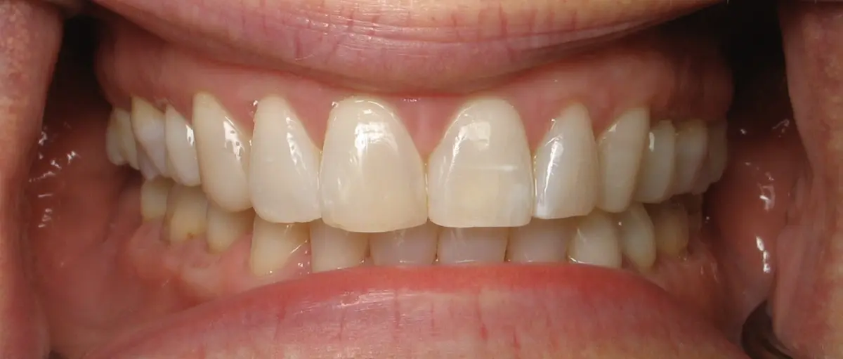 Before — Smile Makeover — Case 4