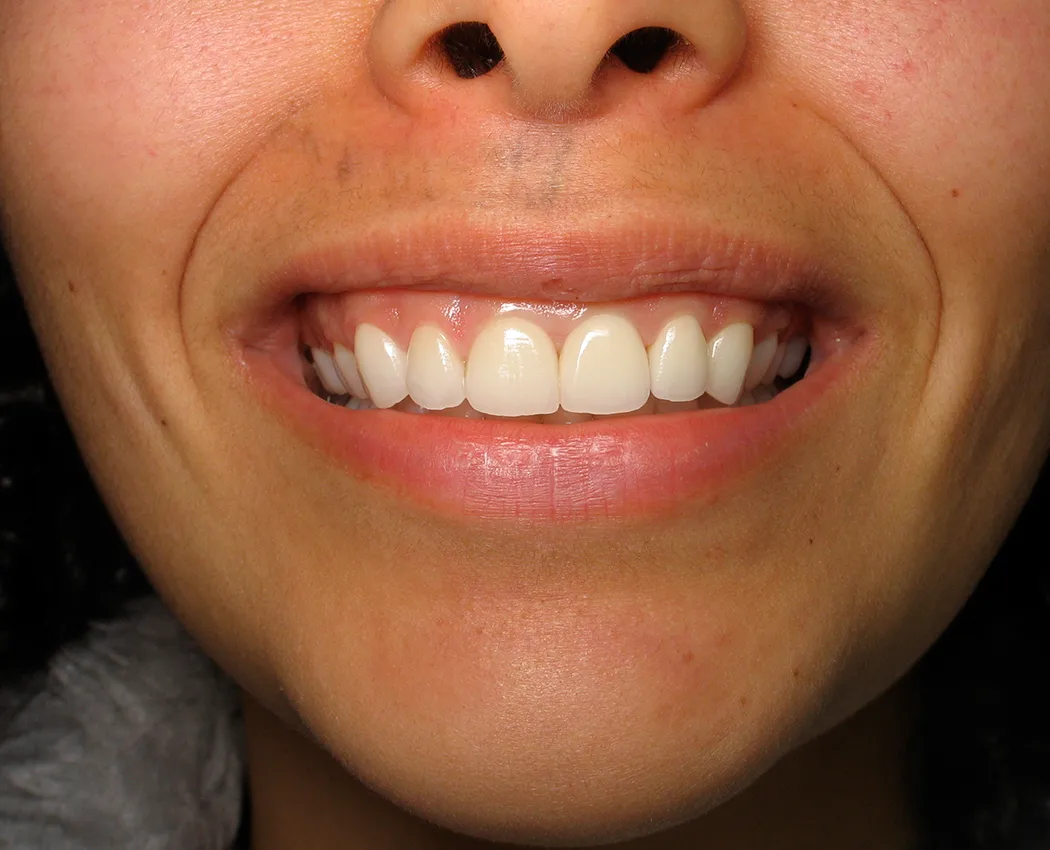 After — Smile Makeover — Case 9
