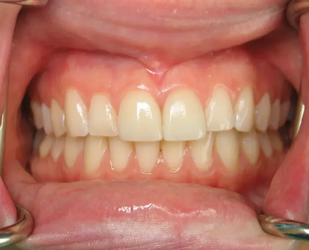 After — Smile Makeover — Case 6