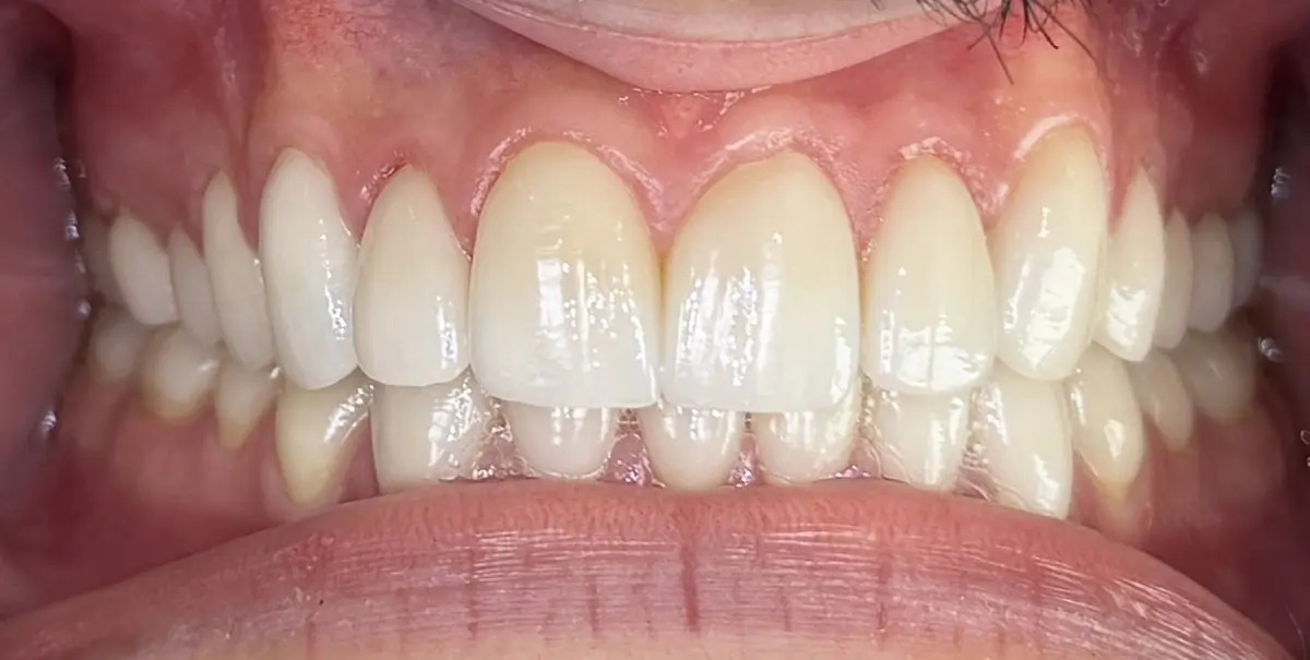 After — Smile Makeover — Case 7