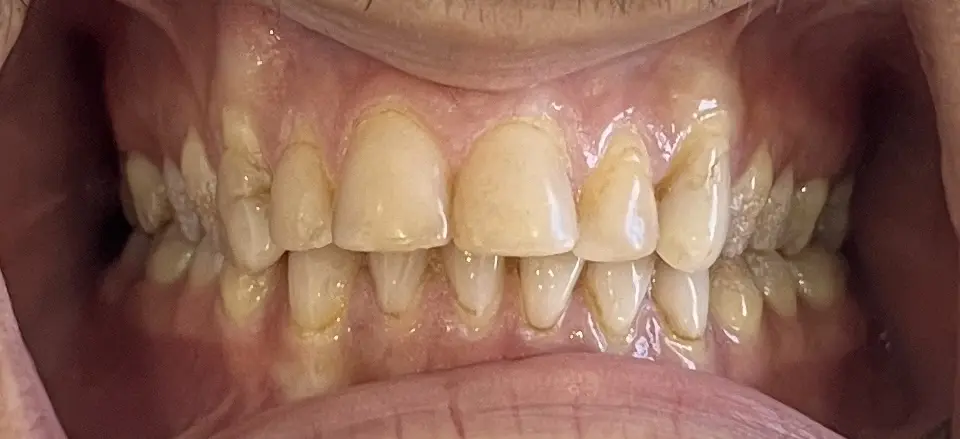Before — Smile Makeover — Case 7