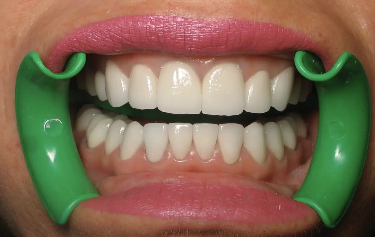 After — Smile Makeover — Case 1