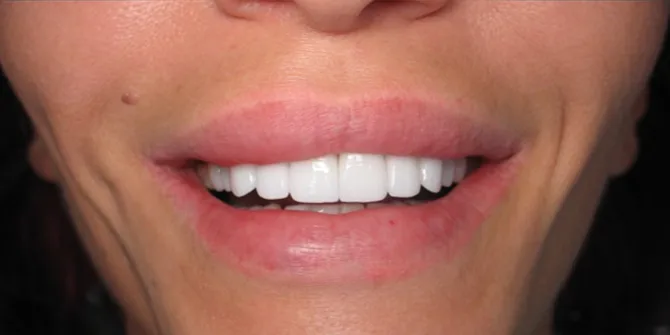 After — Smile Makeover — Case 8