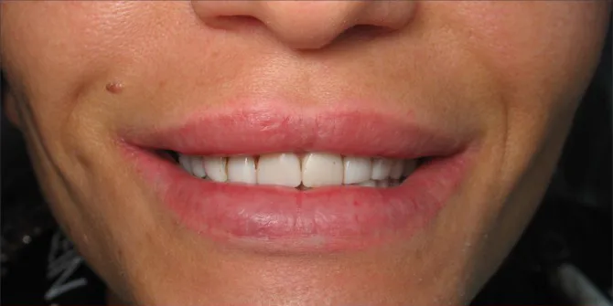 Before — Smile Makeover — Case 8