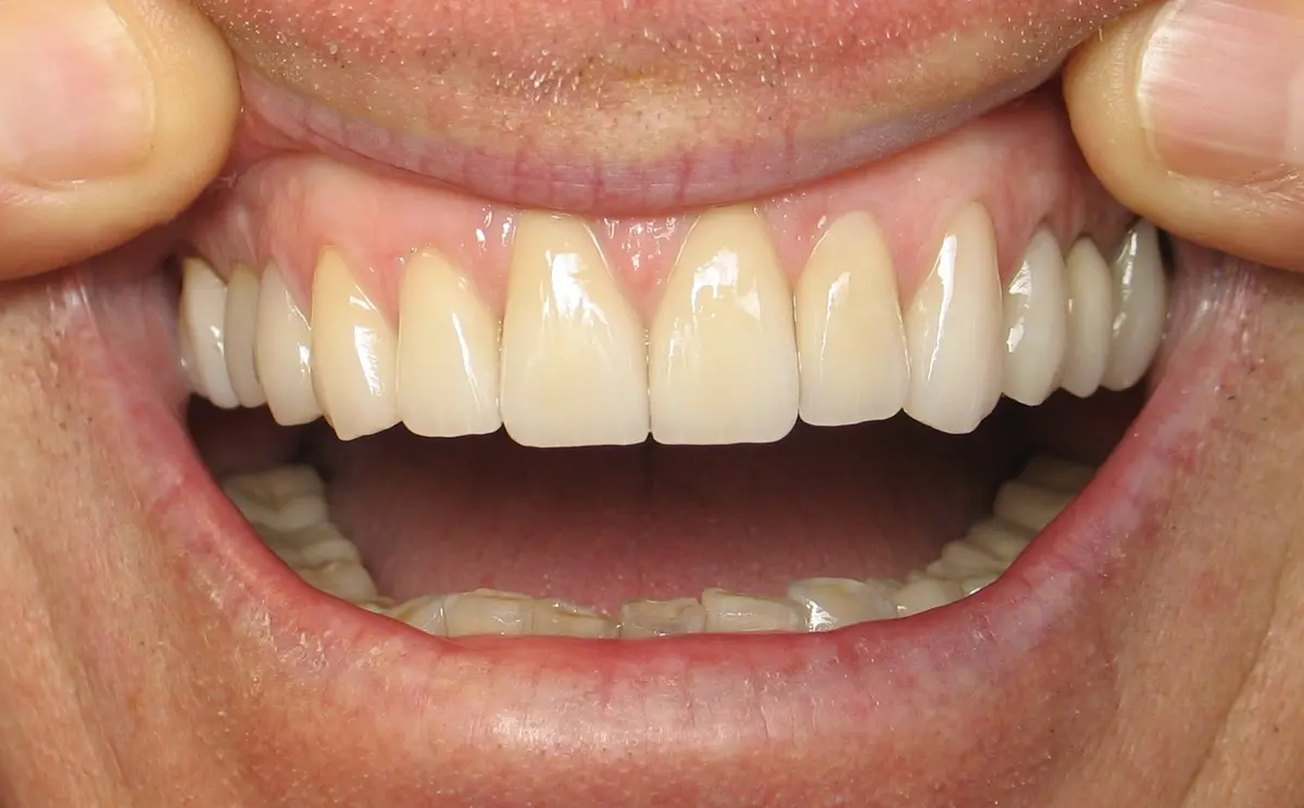 After — Smile Makeover — Case 10