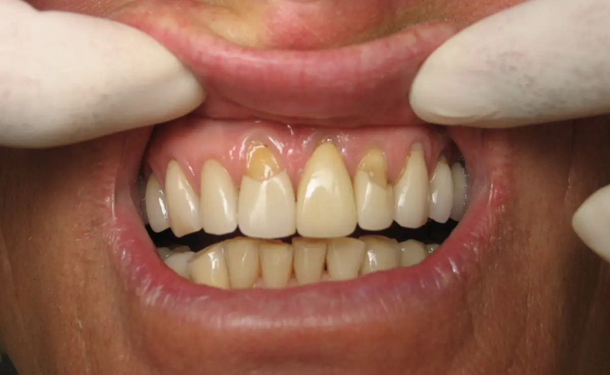 Before — Smile Makeover — Case 10