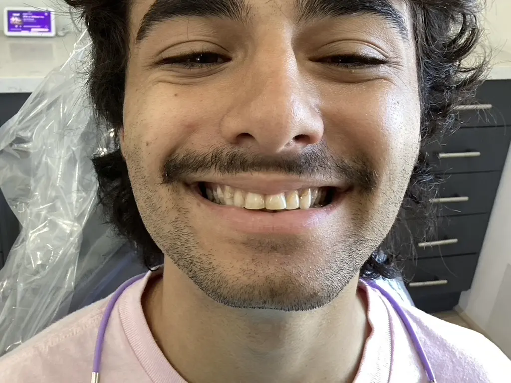 Before — Smile Makeover