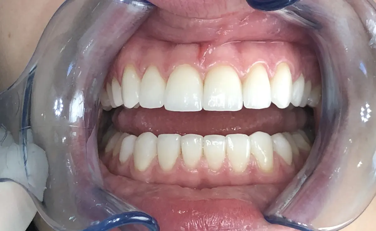 After — Smile Makeover — Case 3