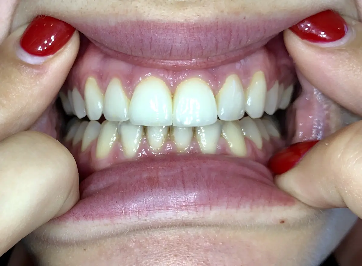 Before — Smile Makeover — Case 3