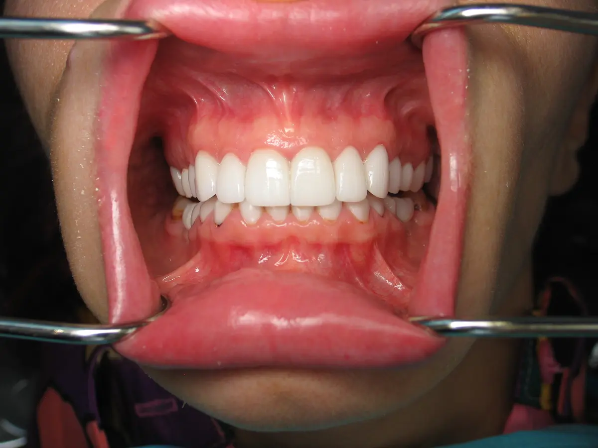 After — Smile Makeover — Case 5