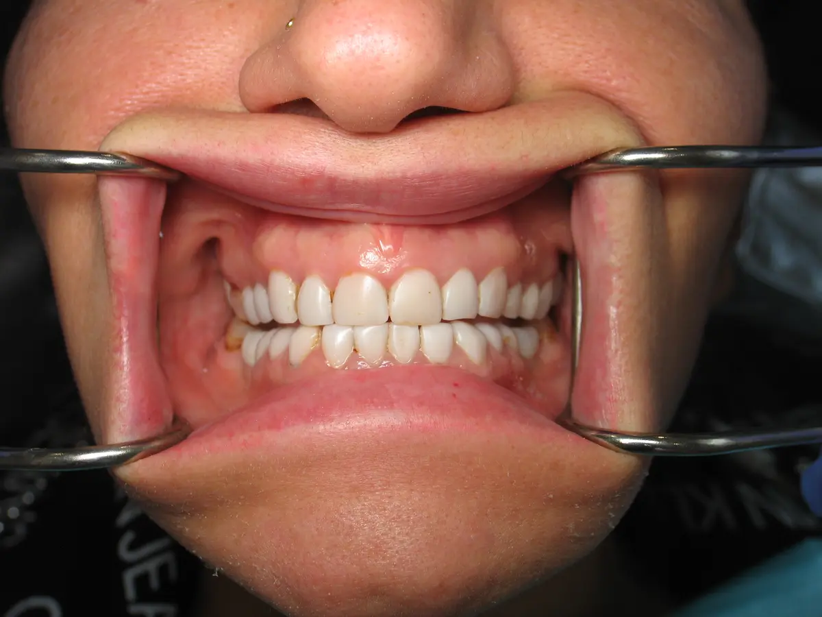 Before — Smile Makeover — Case 5