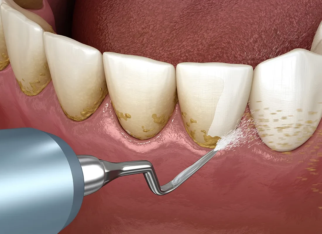 What Is a Deep Cleaning at the Dentist and Do You Really Need One — Beverly Hills Cosmetic Dentistry