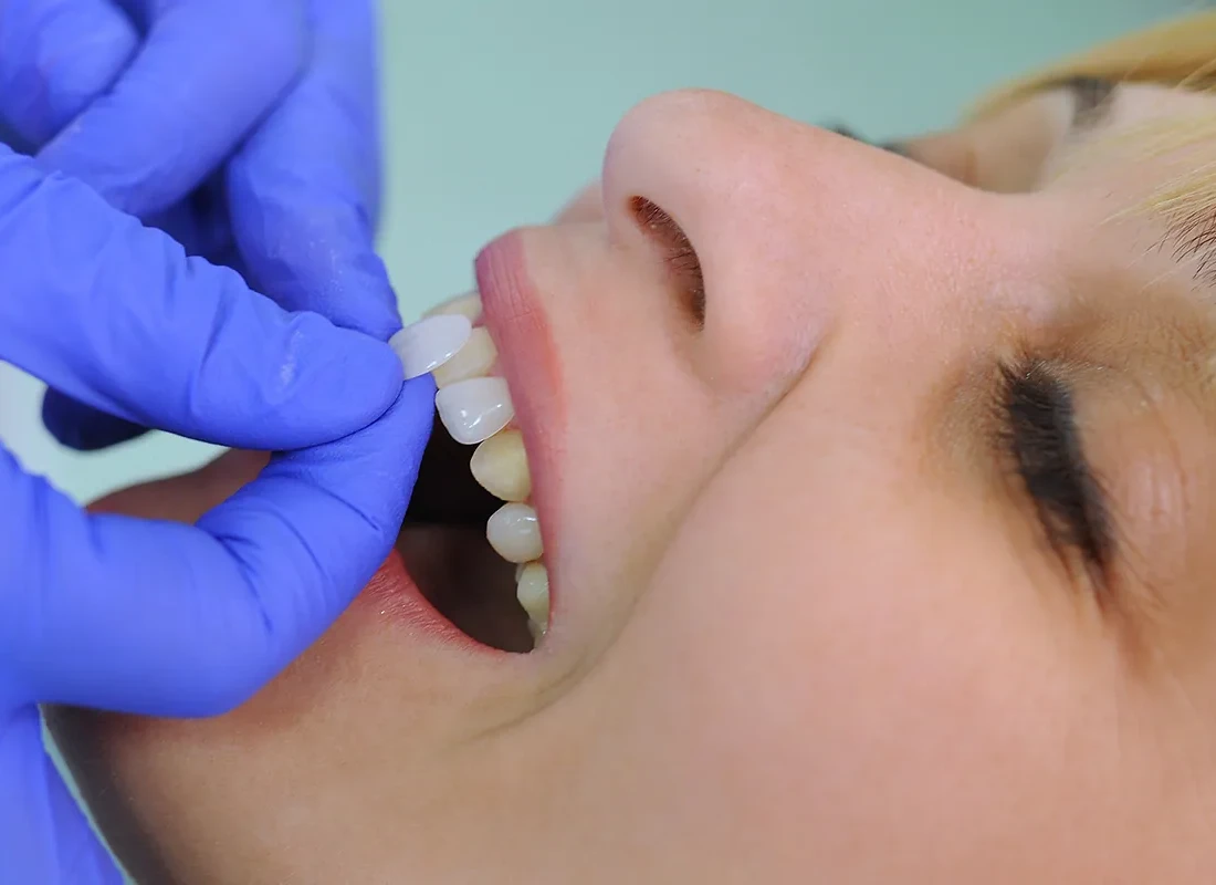 Beyond Fineness: Revolutionize Your Smile with Ultimate Porcelain Veneers in Beverly Hills — Beverly Hills Cosmetic Dentistry