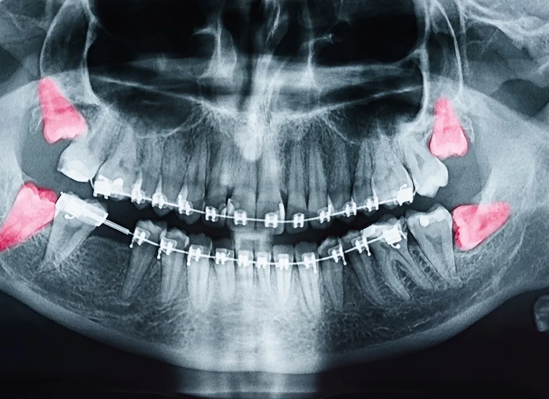 How Do I Know When My Wisdom Teeth Need to Come Out — Beverly Hills Cosmetic Dentistry